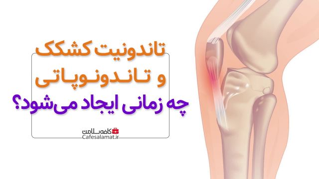تاندونیت کشکک و تاندونوپاتی چه زمانی ایجاد می‌شود؟