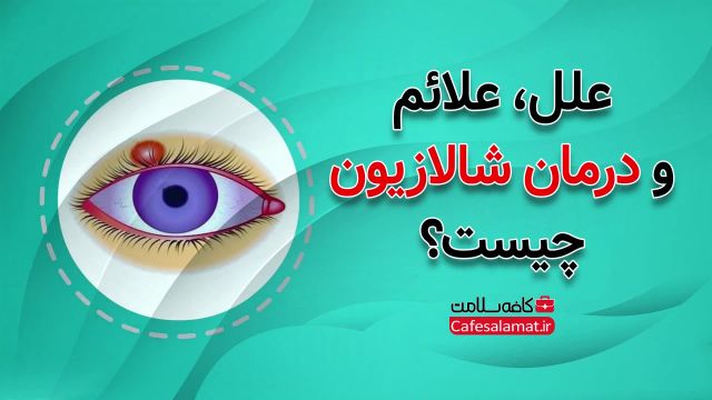 علل، علائم و درمان شالازیون چیست؟