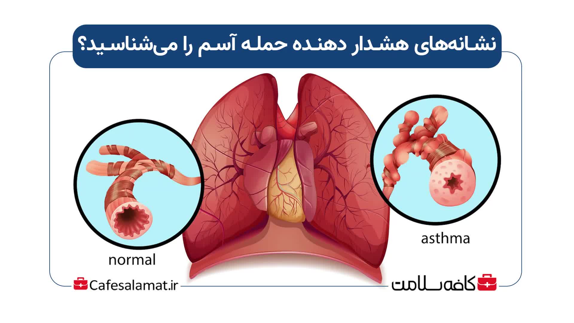 نشانه‌های هشدار دهنده حمله آسم را می‌شناسید؟
