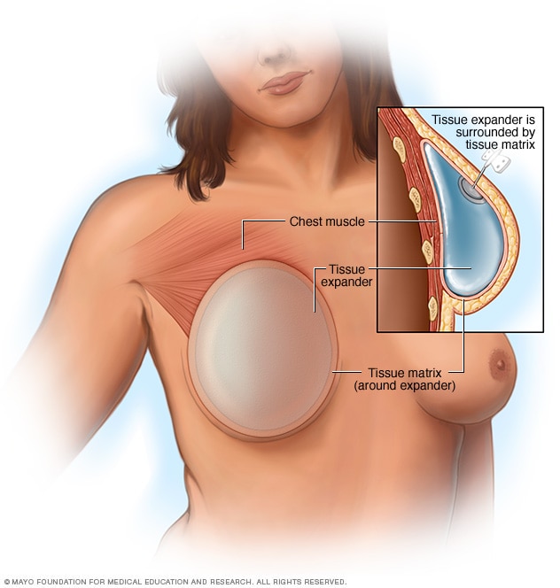 بازسازی سینه با ایمپلنت سینه در بالای عضله قفسه سینه