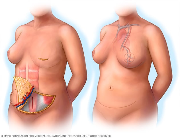 در حین و بعد از تصاویر بازسازی سینه با استفاده از روش فلپ DIEP