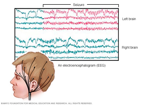 فعالیت مغزی EEG