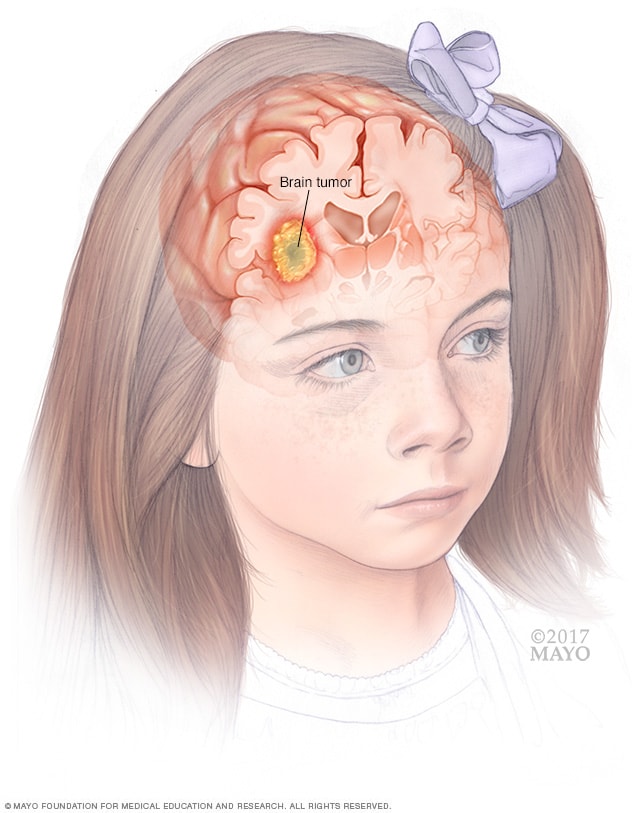 تومور مغزی در کودک