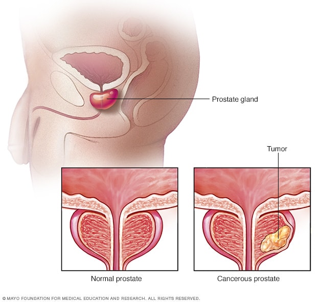 پروستات طبیعی در مقابل پروستات دارای تومور