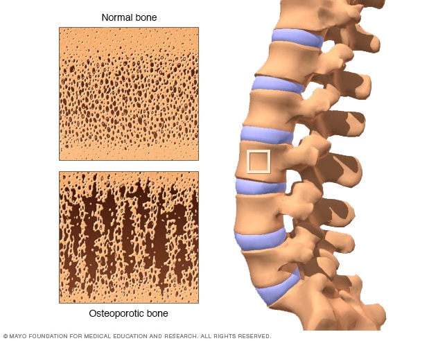 مقایسه فضای داخلی یک استخوان سالم با استخوانی که در اثر پوکی استخوان متخلخل شده است.