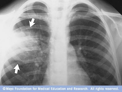 تصویر اشعه ایکس از ریه های مبتلا به ذات الریه