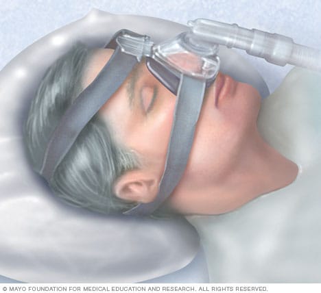 ماسک فشار مثبت مداوم راه هوایی (CPAP).