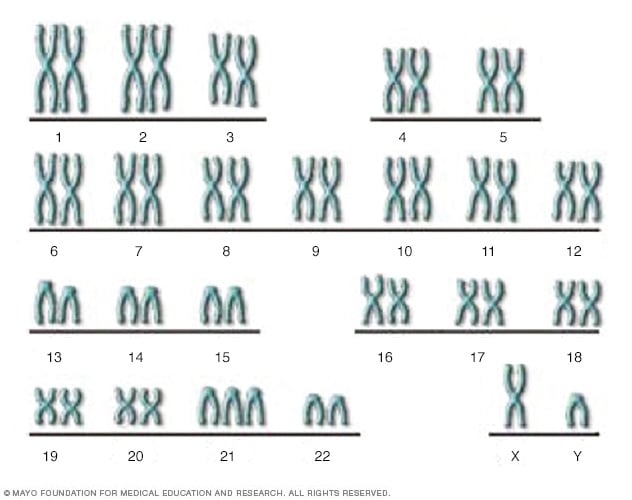 تصویری که کروموزوم های فردی مبتلا به سندرم داون را نشان می دهد