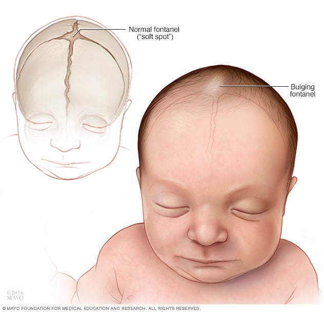 لکه های نرم طبیعی در مقابل غیر طبیعی (فونتانل) جمجمه نوزاد