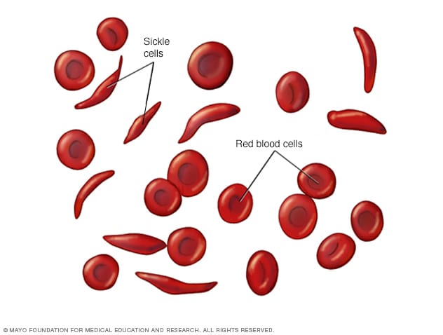 گلبول های قرمز طبیعی و سلول های داسی شکل