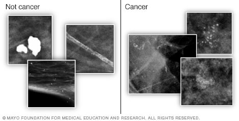 تصاویر ماموگرافی که کلسیفیکاسیون سینه را نشان می دهد