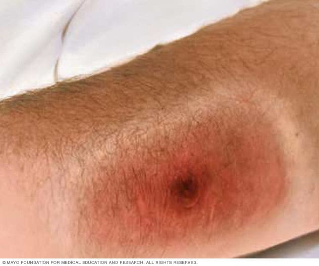 یک زخم بزرگ با مرکز سیاه رنگ که در اثر سیاه زخم پوستی ایجاد می شود