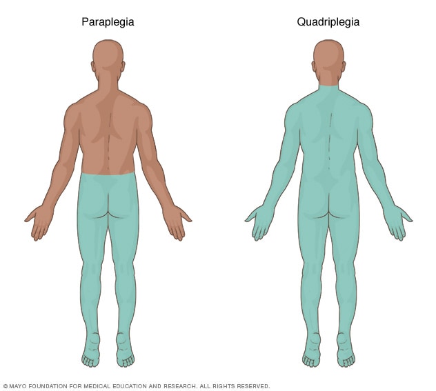 تصویر ناحیه ای از بدن که تحت تاثیر پاراپلژی و چهار پلژی قرار گرفته را نشان می دهد 
