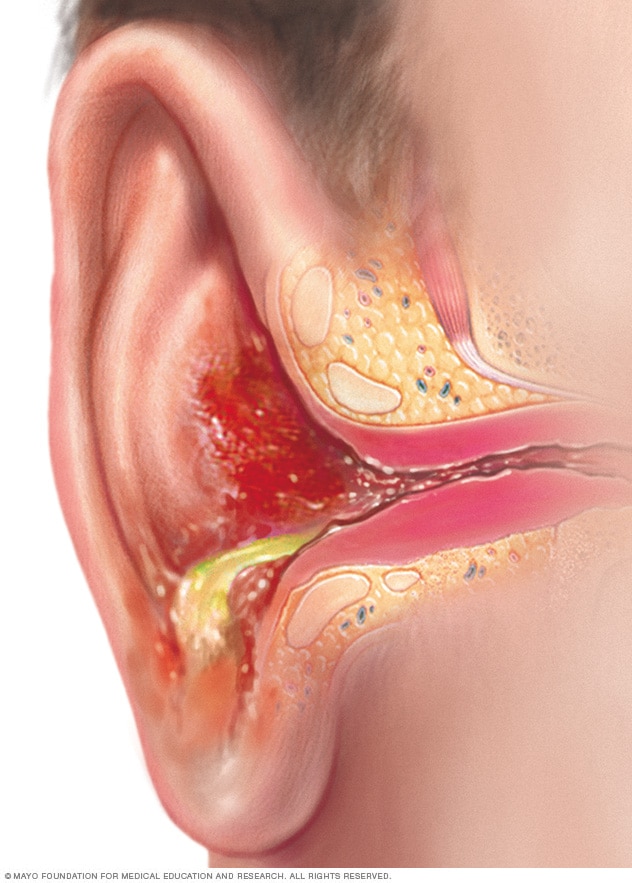 عفونت گوش خارجی