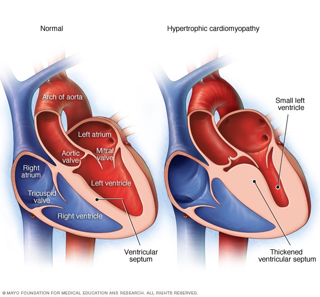قلب و قلب طبیعی با کاردیومیوپاتی هیپرتروفیک