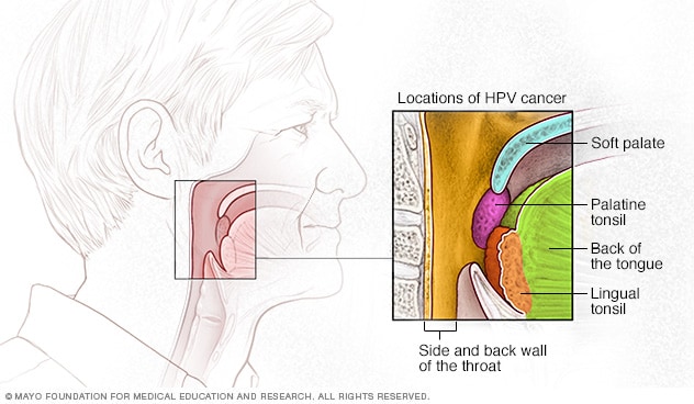 HPV خطر ابتلا به سرطان گلو، کام، لوزه ها و پشت زبان را افزایش می دهد.