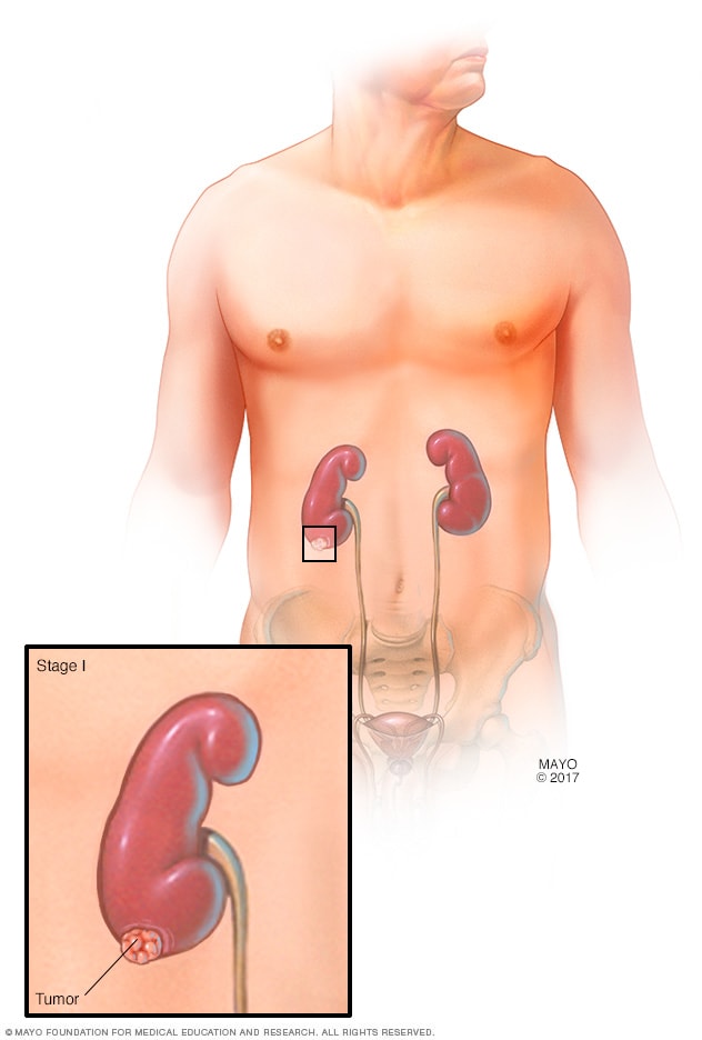 مرحله اول تومور کلیه