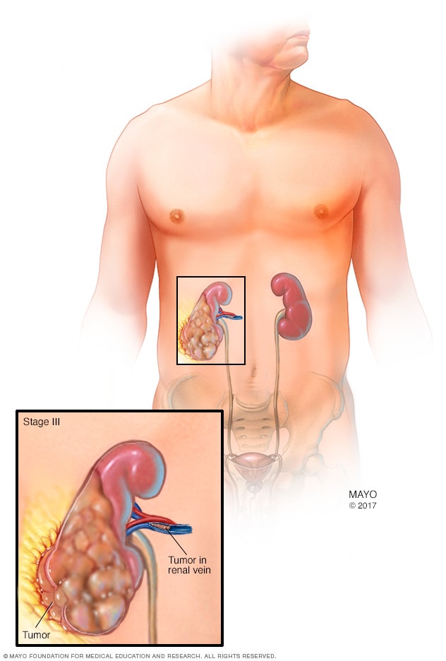 مرحله سوم تاریخ کلیه