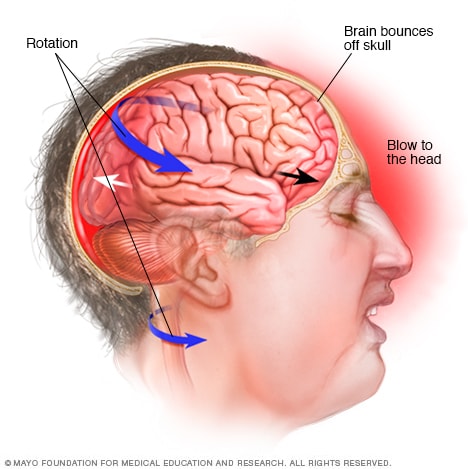 یک تکان حرکتی مغز را در داخل سر می دهد.