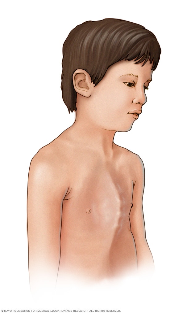 کودکی با استخوان سینه بیرون زده