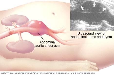 تصویری که سونوگرافی شکمی آنوریسم آئورت شکمی را نشان می دهد