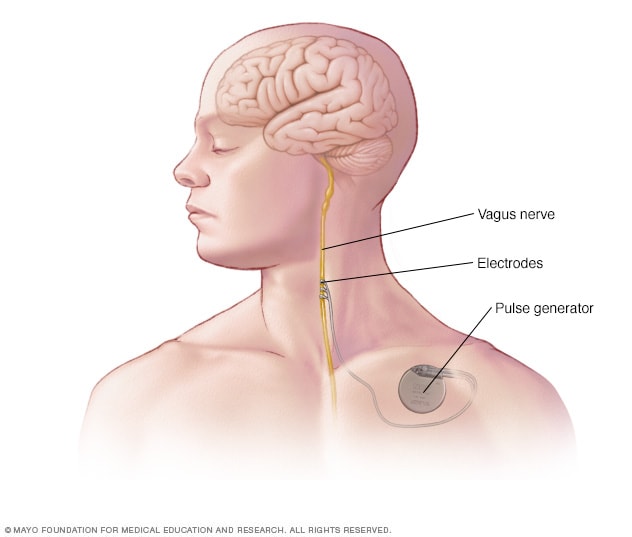 قرار دادن دستگاه در تحریک عصب واگ