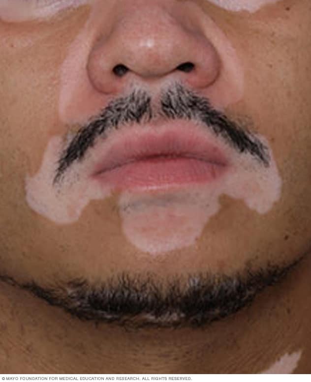 لکه های ویتیلیگو روی صورت