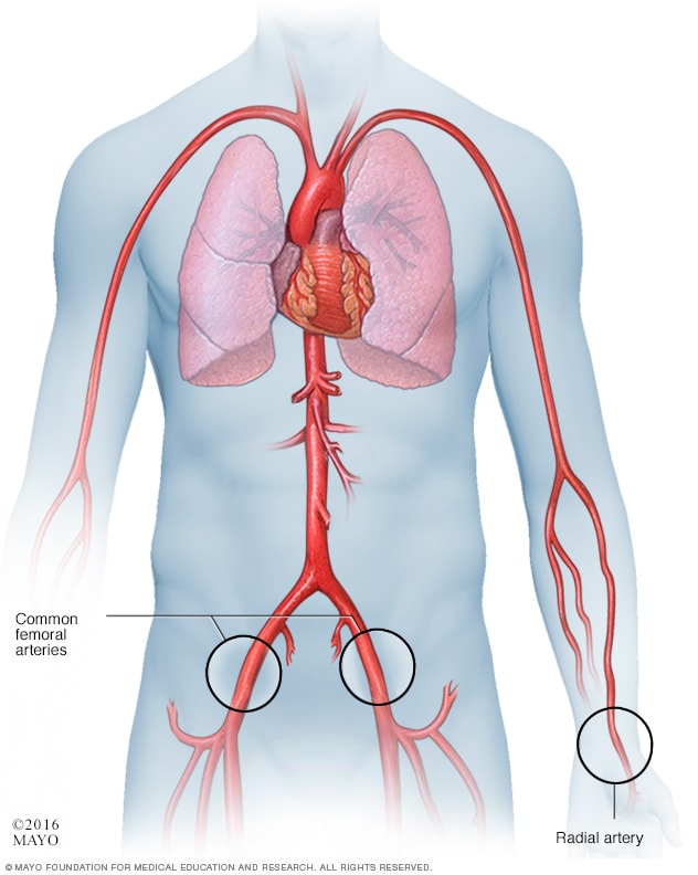 تصویری که رویکردهای کاتتر را در کاتتریزاسیون قلبی نشان می دهد
