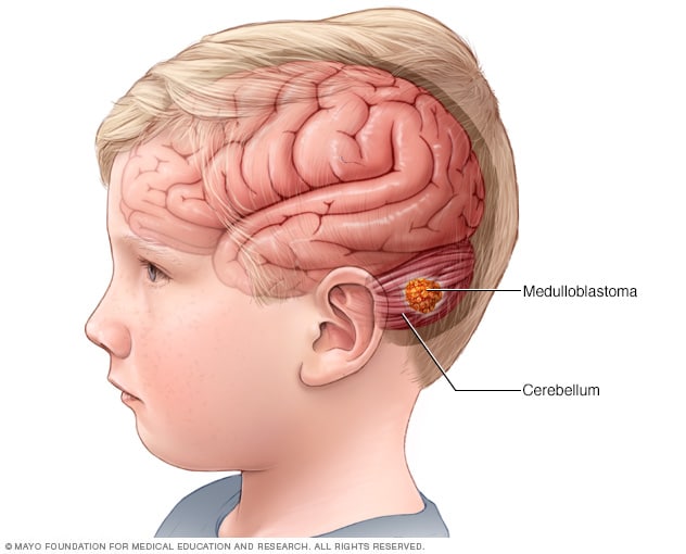 کودک مبتلا به تومور مغزی مدولوبلاستوما