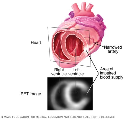 تصویر اسکن PET از قلب