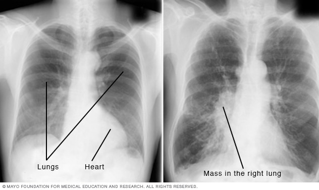 تصویر پزشکی از اشعه ایکس قفسه سینه