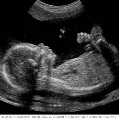 اسلاید سونوگرافی جنین که مشخصات نوزاد را نشان می دهد