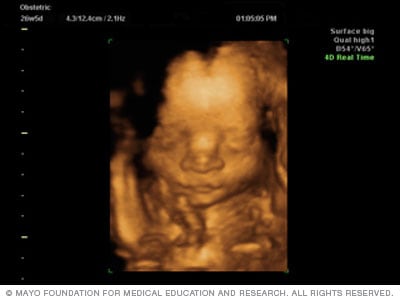 اسلاید سونوگرافی سه بعدی جنین که نوزاد را نشان می دهد
