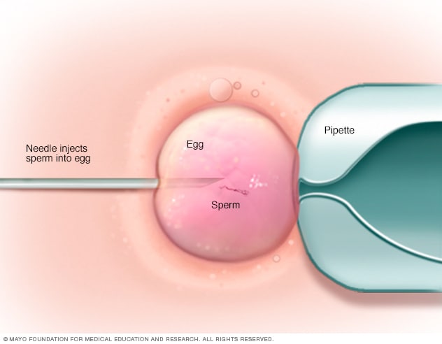 تکنیک تزریق اسپرم داخل سیتوپلاسمی (ICSI).