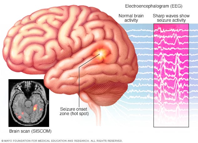 الکتروانسفالوگرام (EEG) که فعالیت های تشنجی را در مغز نشان می دهد