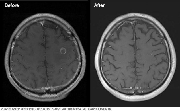 تومور مغزی قبل و بعد از درمان