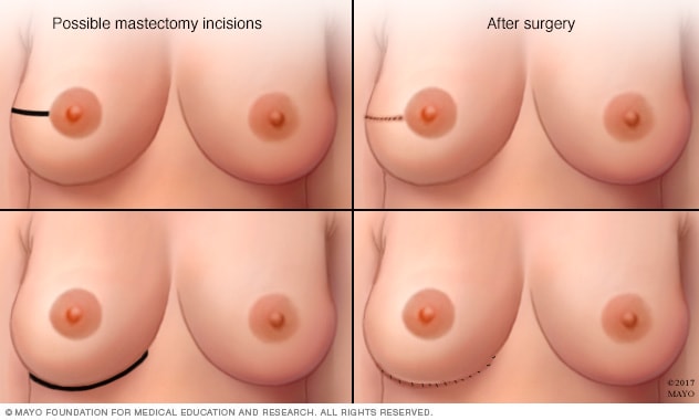 برش‌های رایجی که در طول ماستکتومی نگهدارنده نوک پستان استفاده می‌شود