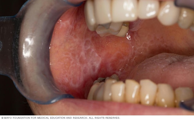 ضایعات لیکن پلان دهان باعث ایجاد لکه های سفید توری در دهان می شود.