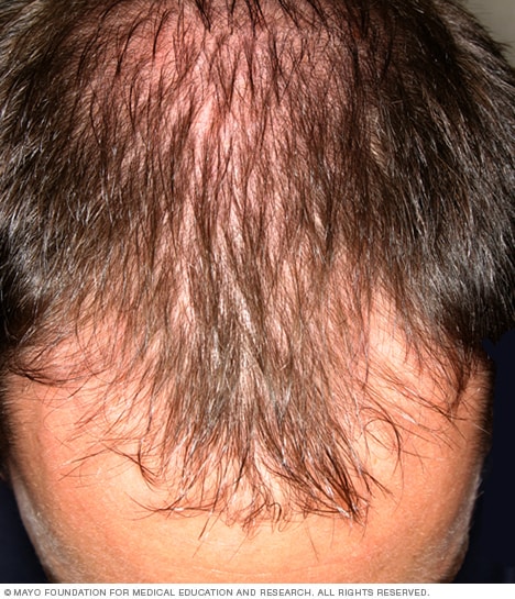 در مردان، موها اغلب از پیشانی شروع به عقب نشینی می کنند.