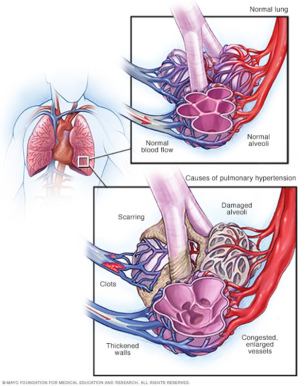 جریان خون در ریه ها و شریان های ریوی طبیعی و مسدود شده است