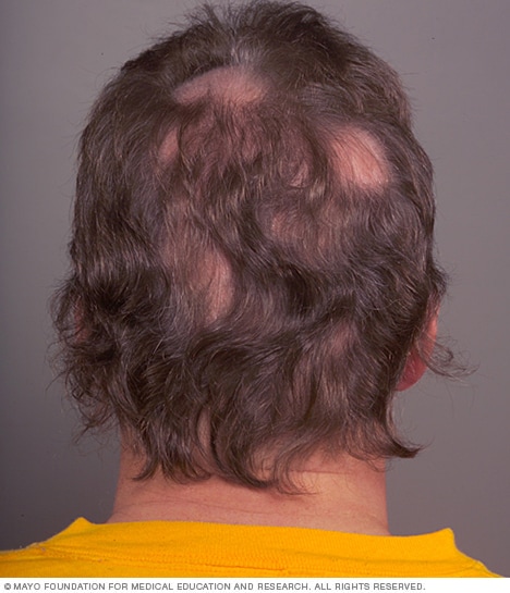 ریزش موی تکه تکه (آلوپسی آره آتا) گاهی اوقات با خارش یا درد سر همراه است.