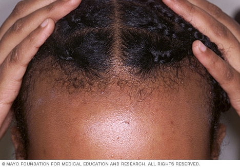 استرس مکرر روی مو می تواند باعث نوعی ریزش مو به نام آلوپسی کششی شود.